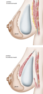 augmentation mammaire