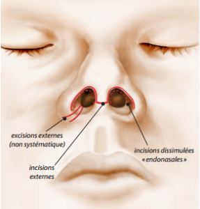 rhinoplastie chirurgien esthétique lyon