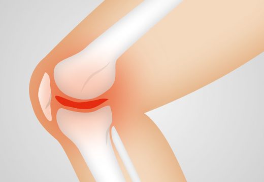 Qu’est-ce que l’arthrose au genou ?