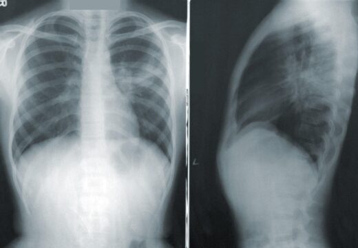 Quand consulter un pneumologue ?