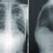 Quand consulter un pneumologue ?